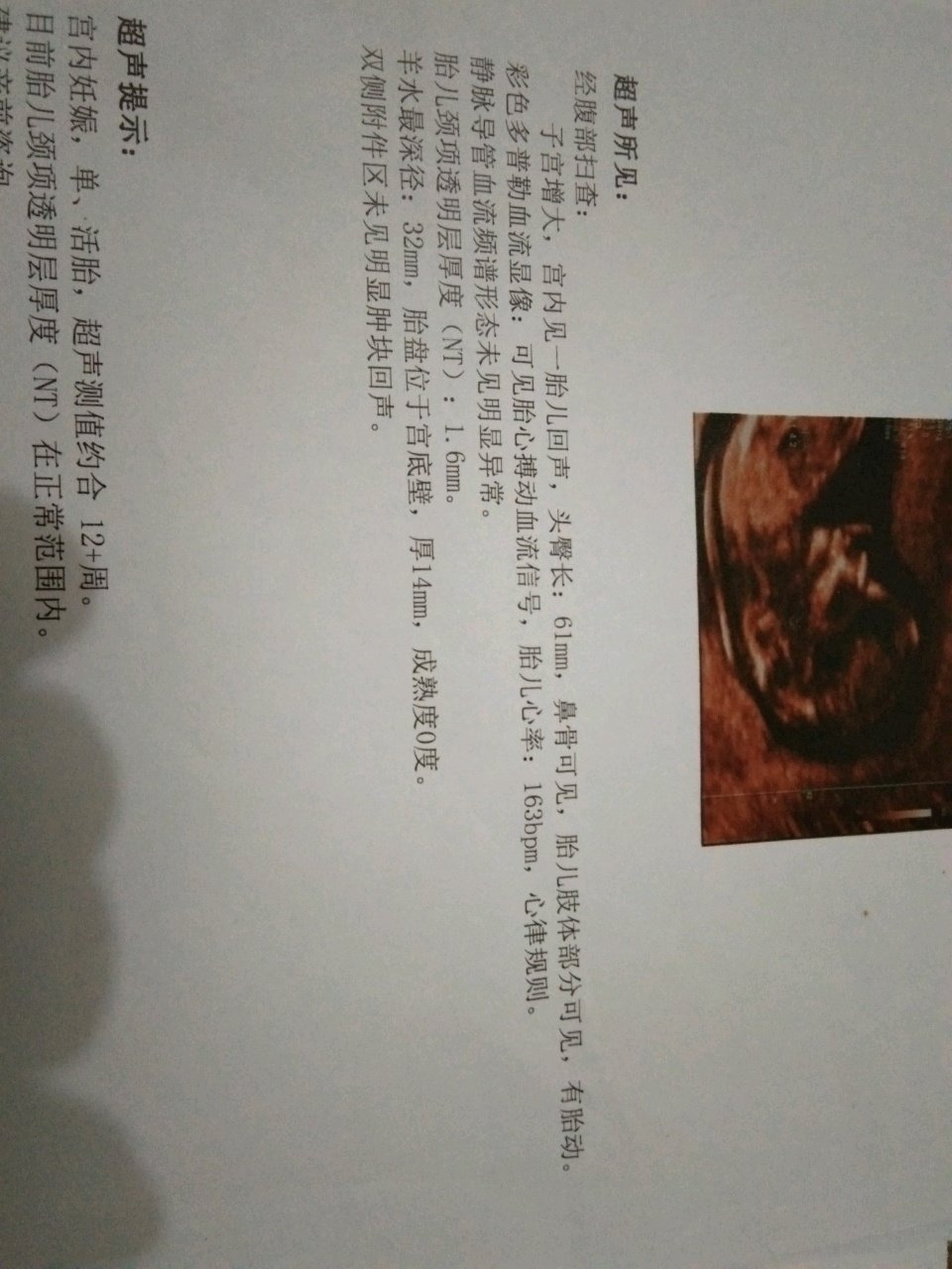 有会看NT单的宝妈吗