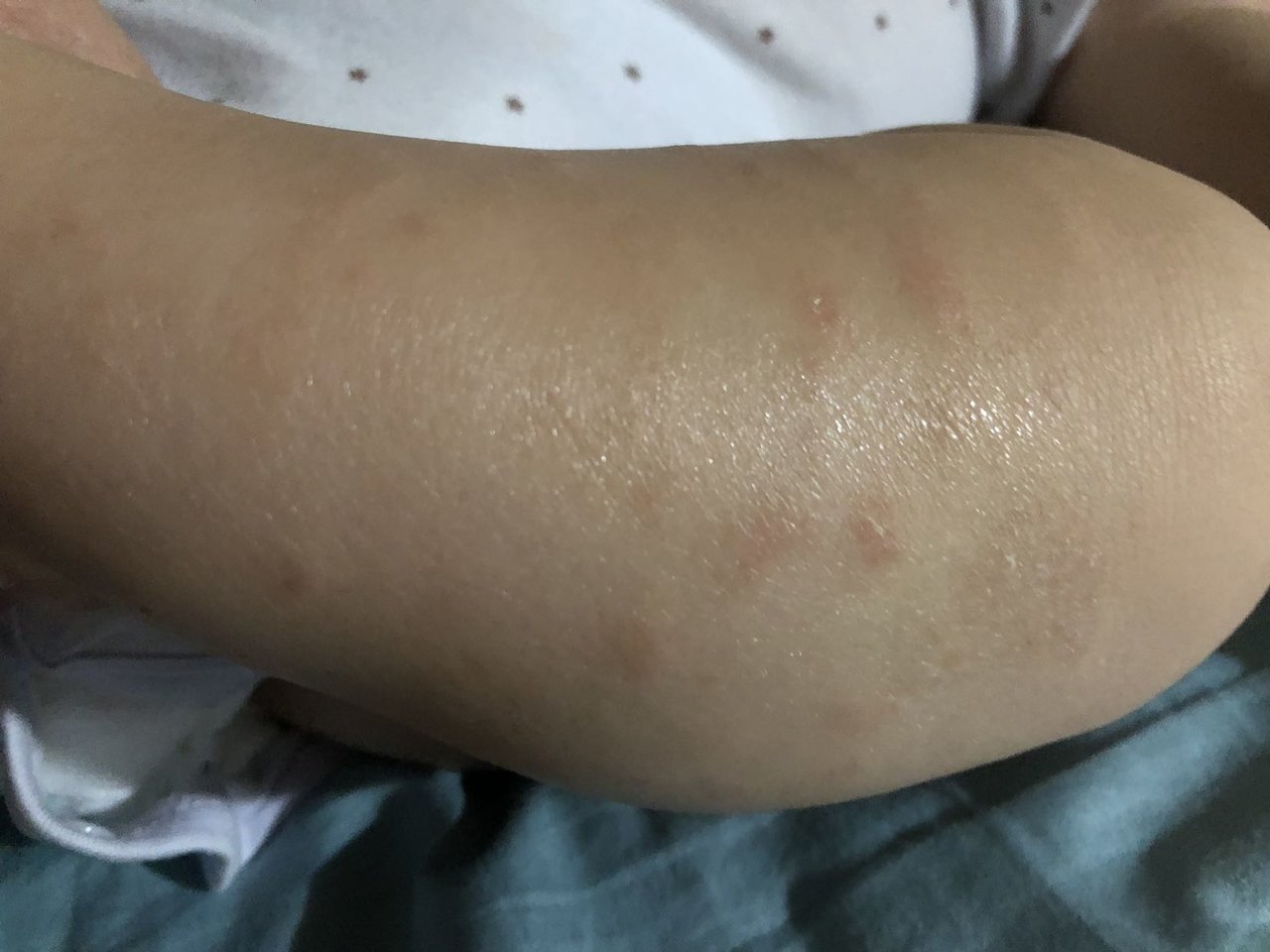 過敏寶寶 異位性皮膚炎