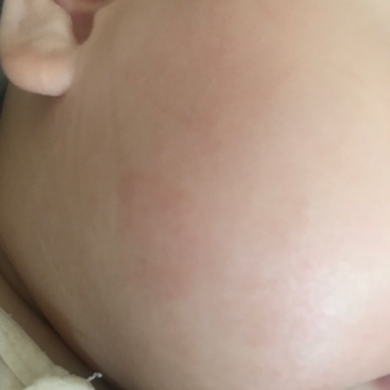 宝宝脸部这是什么原因造成的？怎么处理？大概快两个星期了！