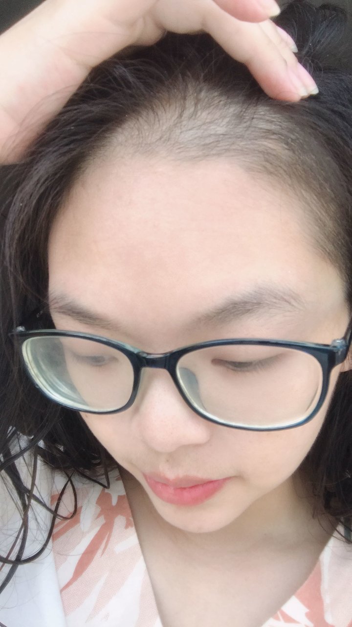 有没有跟我一样哺乳期快掉成秃头的宝妈？
