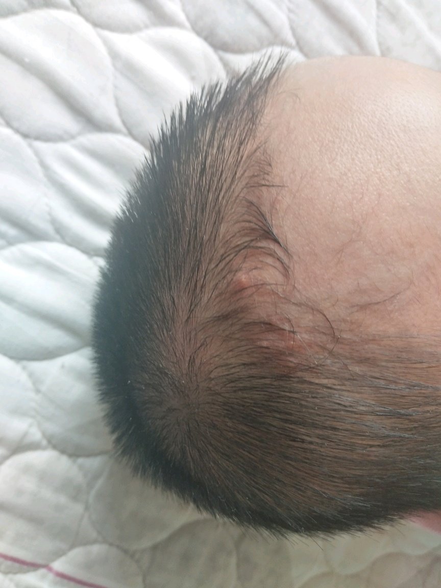 毛囊炎