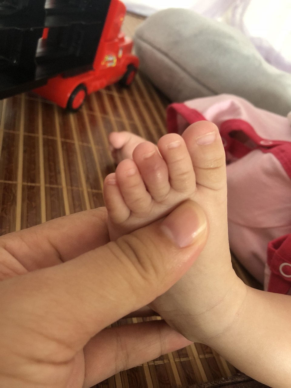 宝宝脚趾肿大