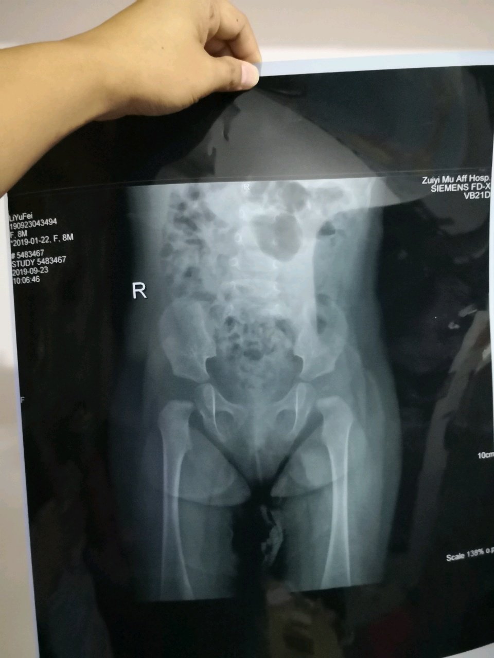 髋关节