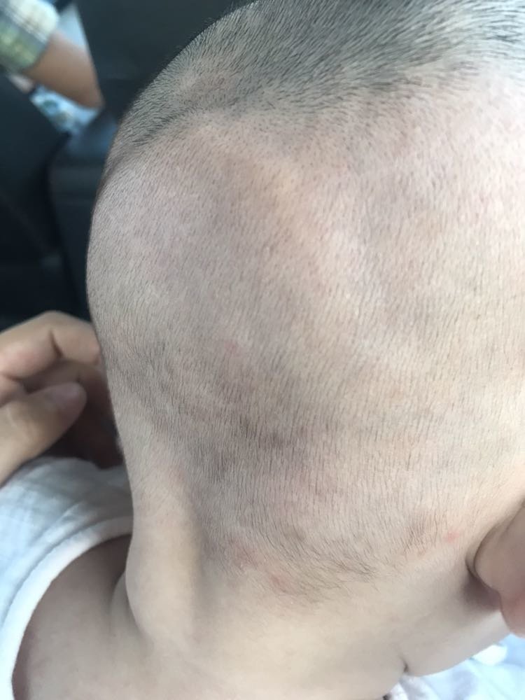 后枕骨凸出，有同款吗