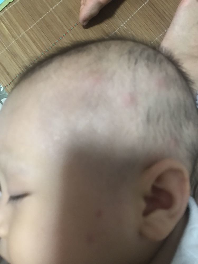 求助，宝宝头上长了一圈这样的疙瘩，感觉不像蚊子咬的
