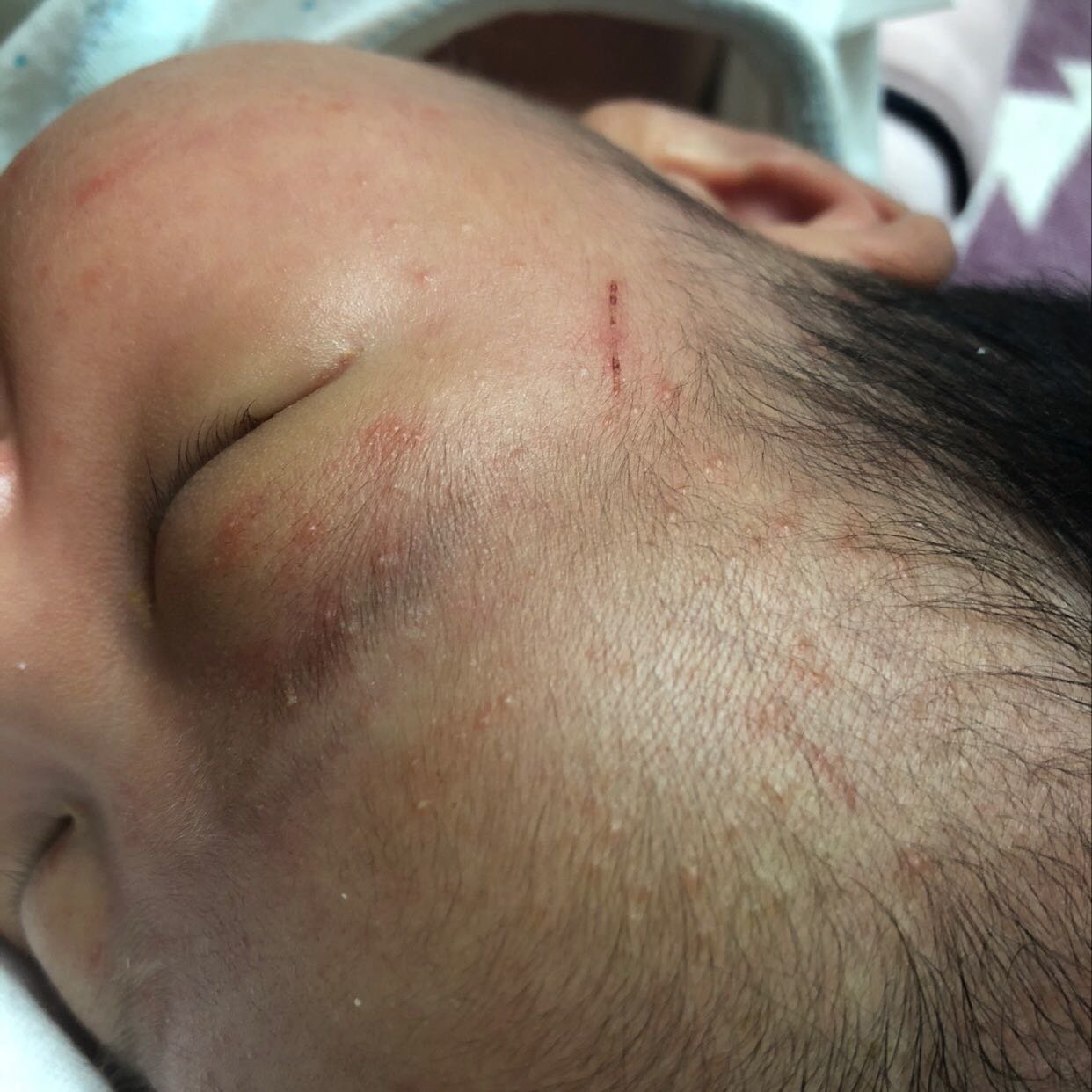 求帮助，新生儿面部起这种疹子是什么？？？
