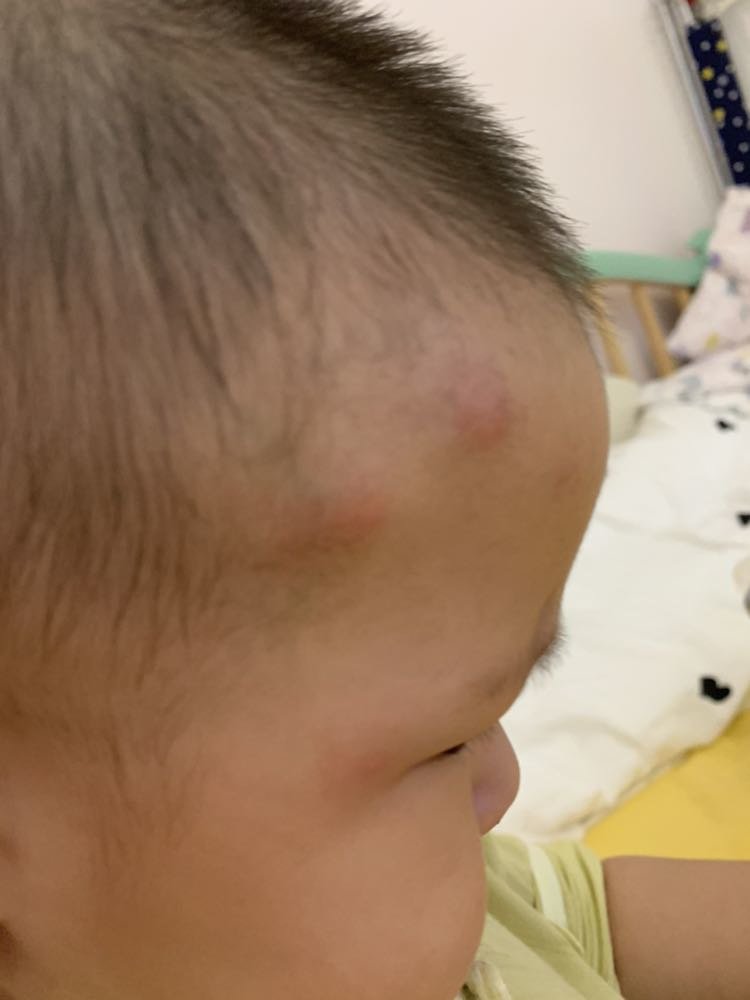 额头长了几个鼓鼓的包