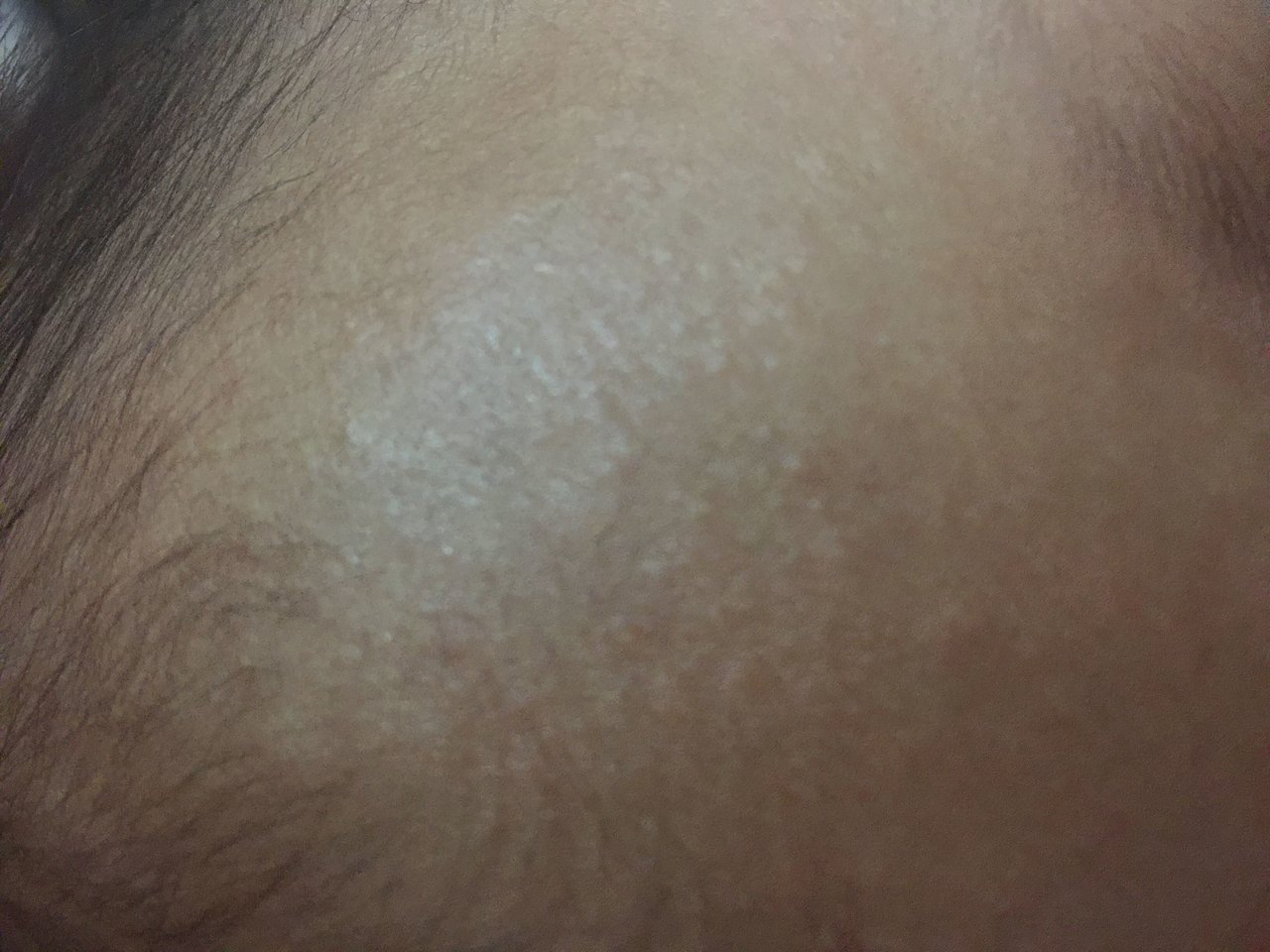 请问这是湿疹吗