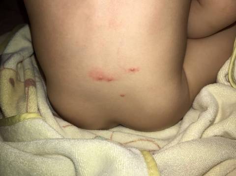宝宝身上长了挺多这种小水泡是什么来的