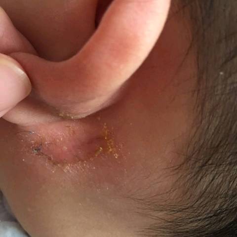 宝宝耳朵后面湿湿的,还结痂,是不是湿疹?