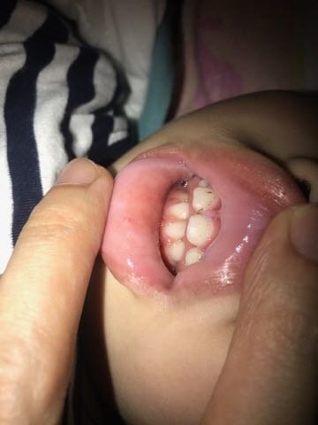 各位爸妈有没有遇到这个情况？？牙齿问题