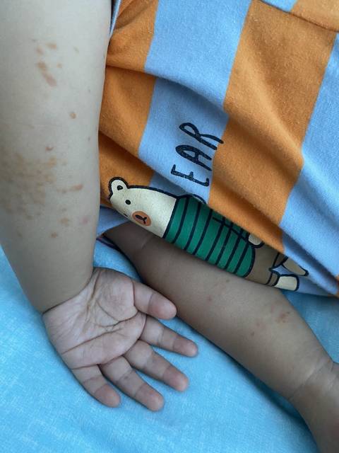 黄瘤病,黄色肉芽,黄色瘤