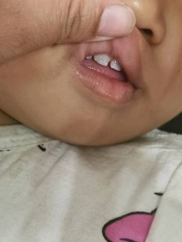 婴儿正常牙齿白斑图片图片