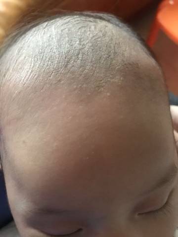 宝宝头皮毛囊损伤图片图片