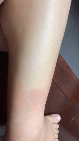 孕晚期大腿泛红一片,是怎么回事呢?