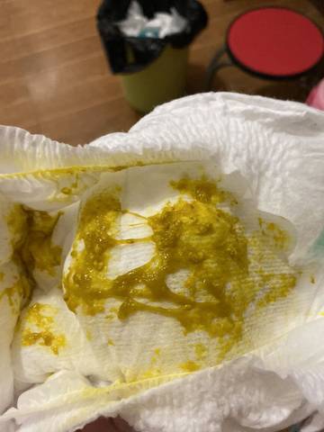 宝宝26天,纯母乳,今天便便粘稠,有奶瓣,是怎么回事?需不需要去医院?