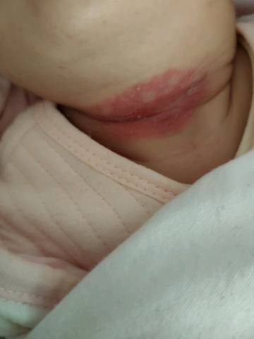 宝宝脖子发红发烂了擦什么药好的快,每天给他擦茶籽油没见一点效果