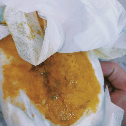 母乳喂养,几乎每次吃每次拉,而且拉的跟水似的,这样的正常吗?