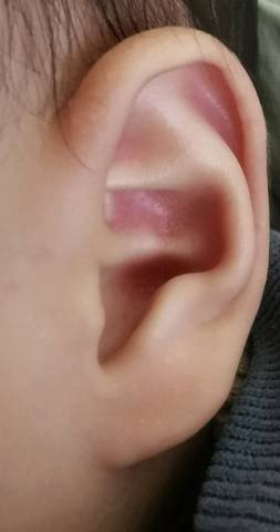 这是中耳炎吗