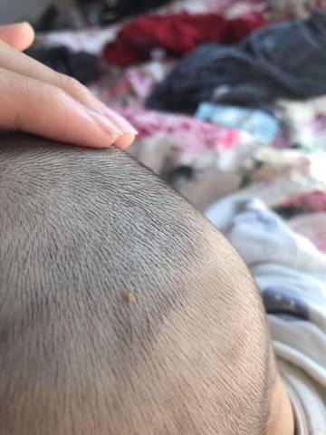 有没有宝宝身上有这种小疙瘩的呀,就在皮肤表面,要不要医院检查一下?