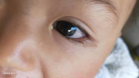 宝宝眼睛有青斑的图片图片