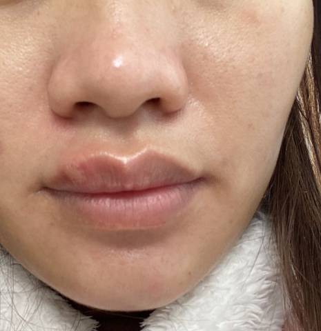 嘴唇长泡了,这是啥,干燥太上火了?