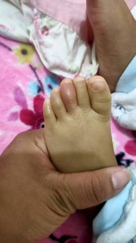 宝宝脚趾头红肿图片图片