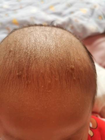 新生儿头上皮脂腺痣图片