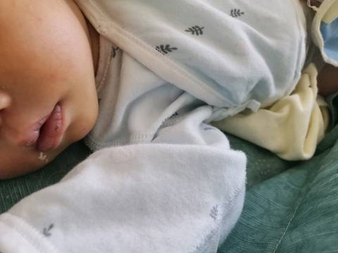 宝宝嘴上的白皮变黑皮是怎么了