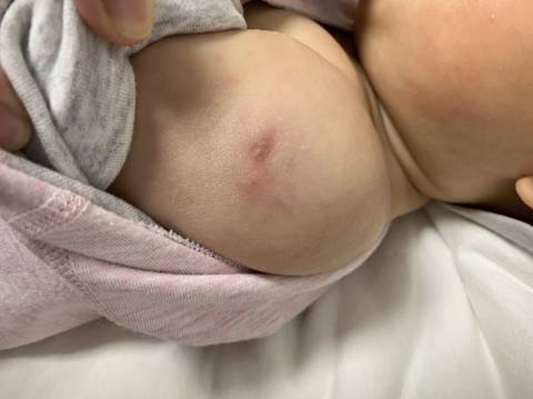 五个月宝宝打针这块有点硬 红 好像周围有点青 怎么办?