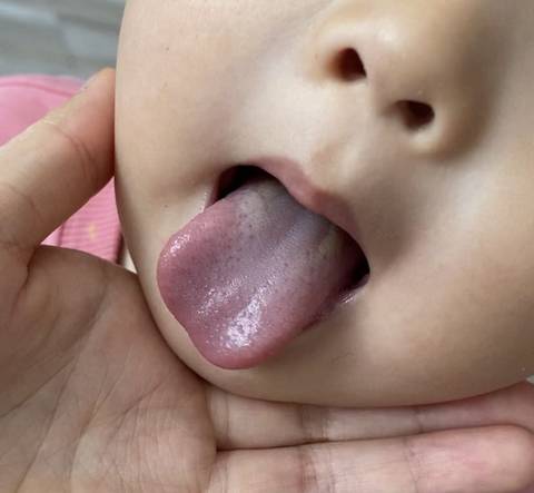 请问孩子舌苔这样是怎么回事?积食了吗?