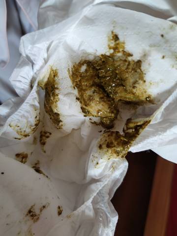 请问,宝宝四个月,腹泻,医生说过敏,喝深度水解奶粉,但还是拉粘液便