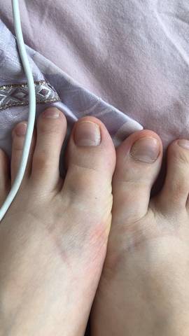 怀孕27周脚指甲盖变紫,一碰还疼就像被砸脚了那种一样,有没有和我一样