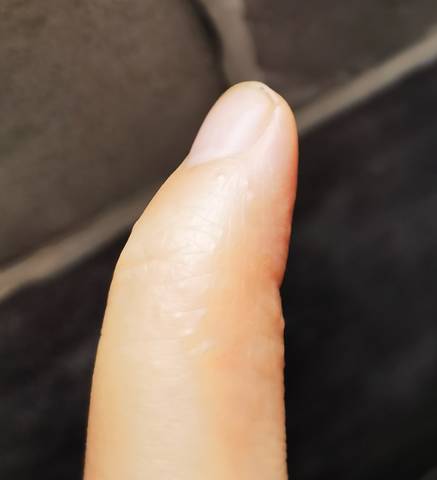 好几根手指都长这种小水泡,有孕妈一样的吗?是什么原因导致的呀?