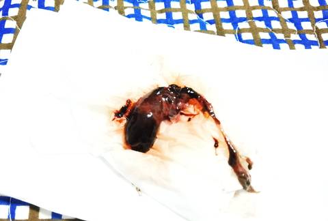 药流第一天在医院排出孕囊,第四天在家流出来一块椭圆形的血块,感觉