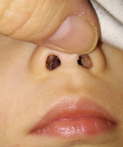 儿童鼻孔内有肉球图片图片