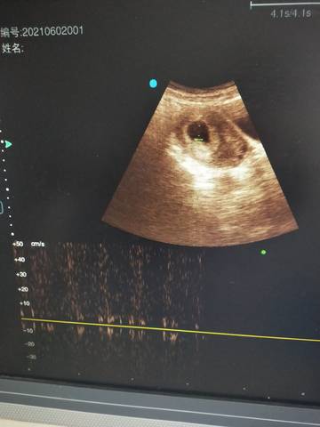 育儿问答 怀孕期 孕7周 彩超图片上有胎心胎芽吗,医生说有,我怎么看是