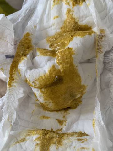 宝宝拉的便便有粘液这是怎么了(有图慎入)