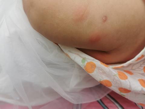 宝宝3个月大身上出现红色肿块!