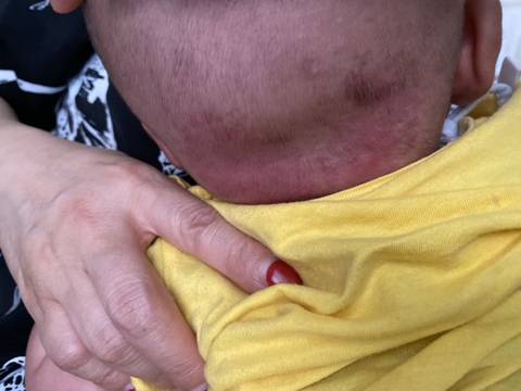 孩子头后面枕了好大一片红的,摸点什么药好的快呢?