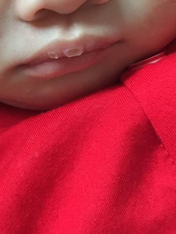 为何宝宝的嘴巴这样啊掉皮