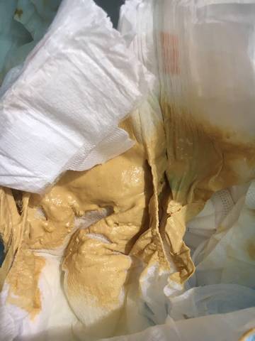 奶粉喂养这几天老是拉这种粑粑和频繁放臭屁,是怎么了