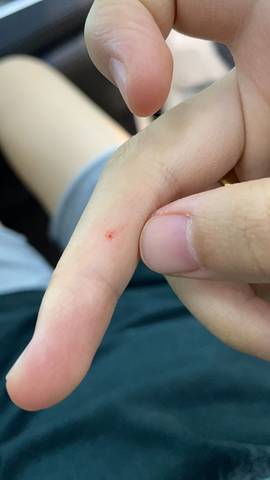 孕29周2了 刚刚被两个月的宠物猫咬到手指头出来一点血 这用不用打