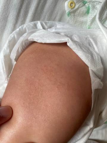 80天,男宝,大腿外侧这个地方摸起来干涩,疙疙瘩瘩的,肚子上有很多小