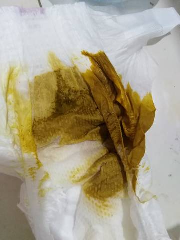 三个多月宝宝母乳喂养,隔一天大便一次,大便吸纸尿裤吸收了,正常吗?