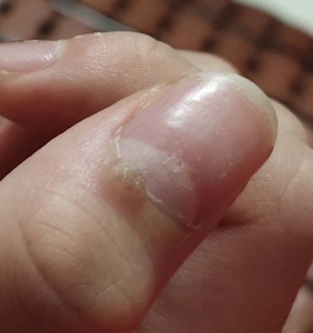 有谁知道手指月牙旁长的这个是什么?