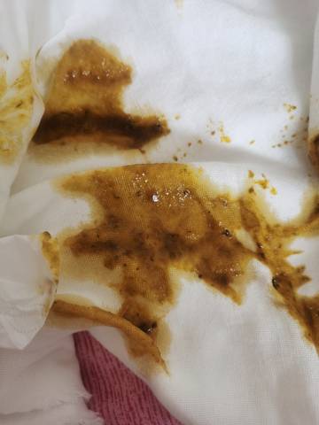 宝宝拉的屎这样正常吗