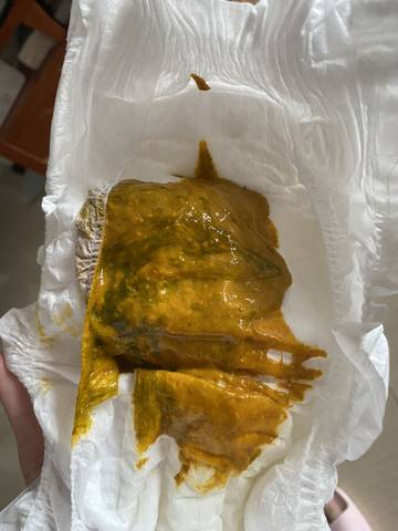 求解:纯母乳喂养宝宝,突然拉带黑绿色便便是什么情况?需不需要就医