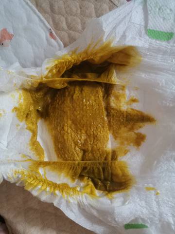 2个月宝宝拉这样的粑粑正常吗,有点发黑,接受不了勿看