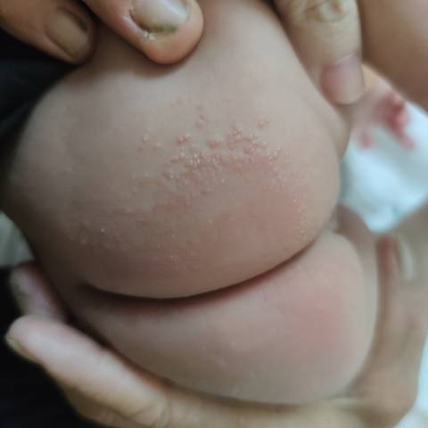 红屁股成这个样子怎么办,都起水泡了